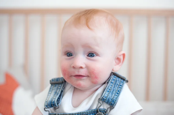 Baby with rash on face.
